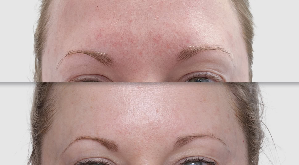 Dull, lacklustre skin before and after at Dr Marion Chan's practice