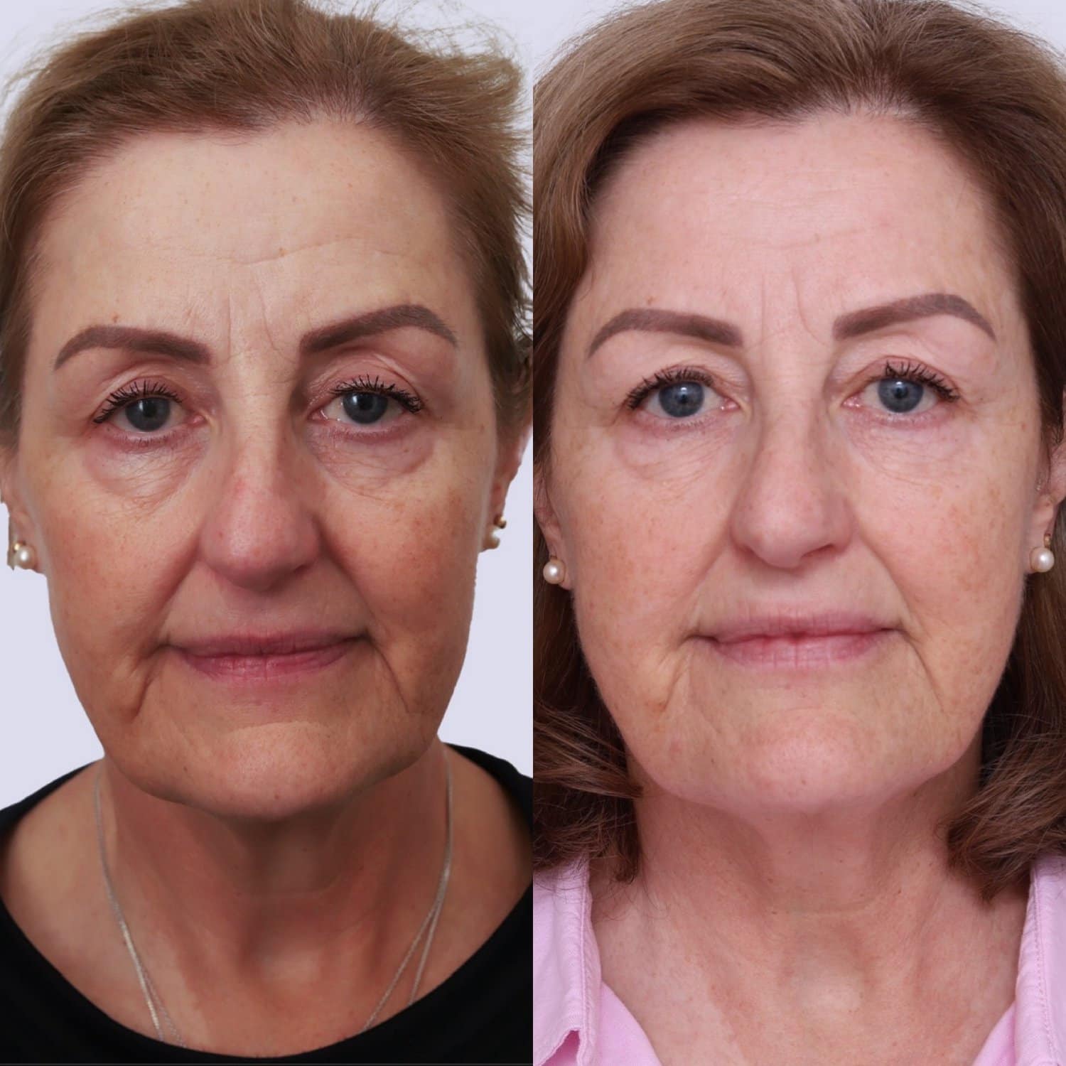Dull, lacklustre skin before and after at Dr Marion Chan's practice