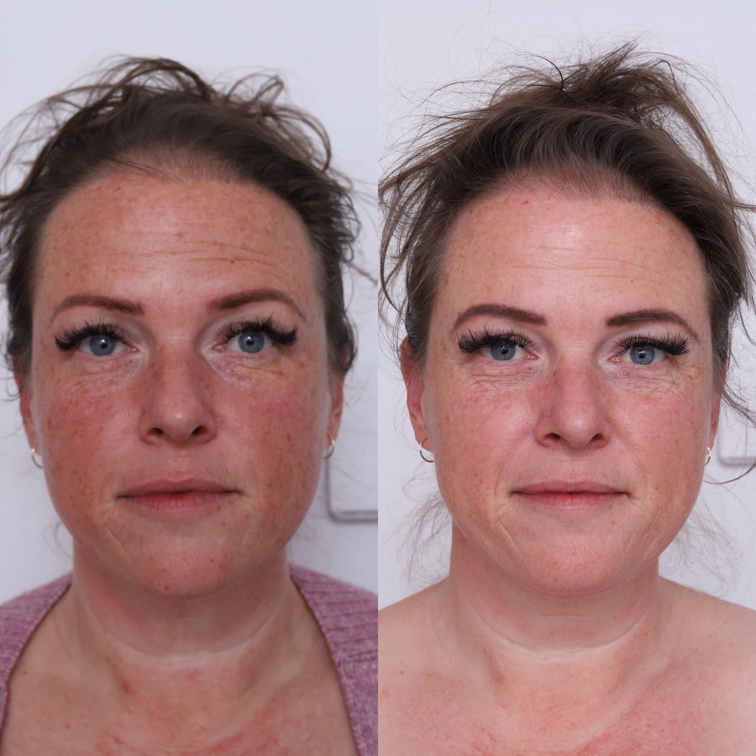 Pigmentation before and after at Dr Marion Chan's practice