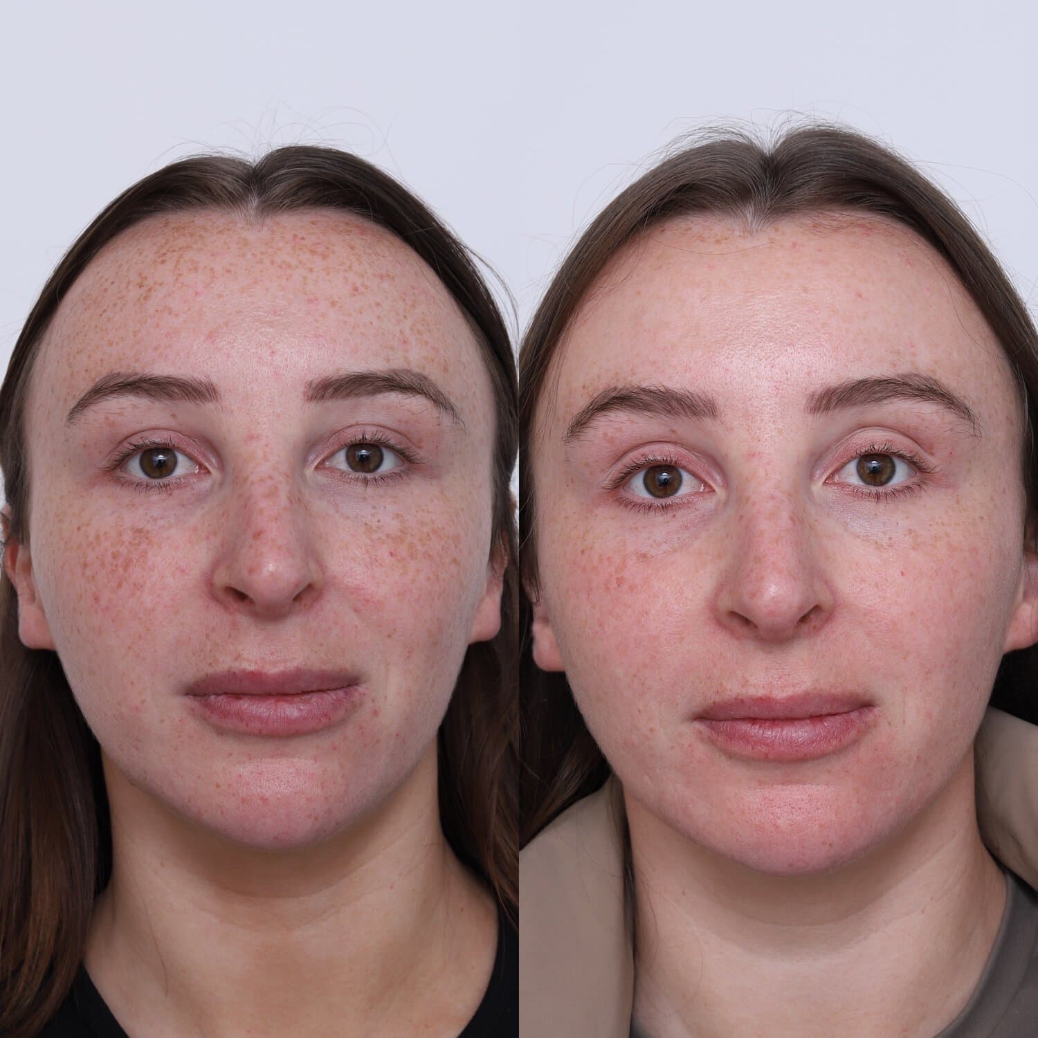 Pigmentation before and after at Dr Marion Chan's practice