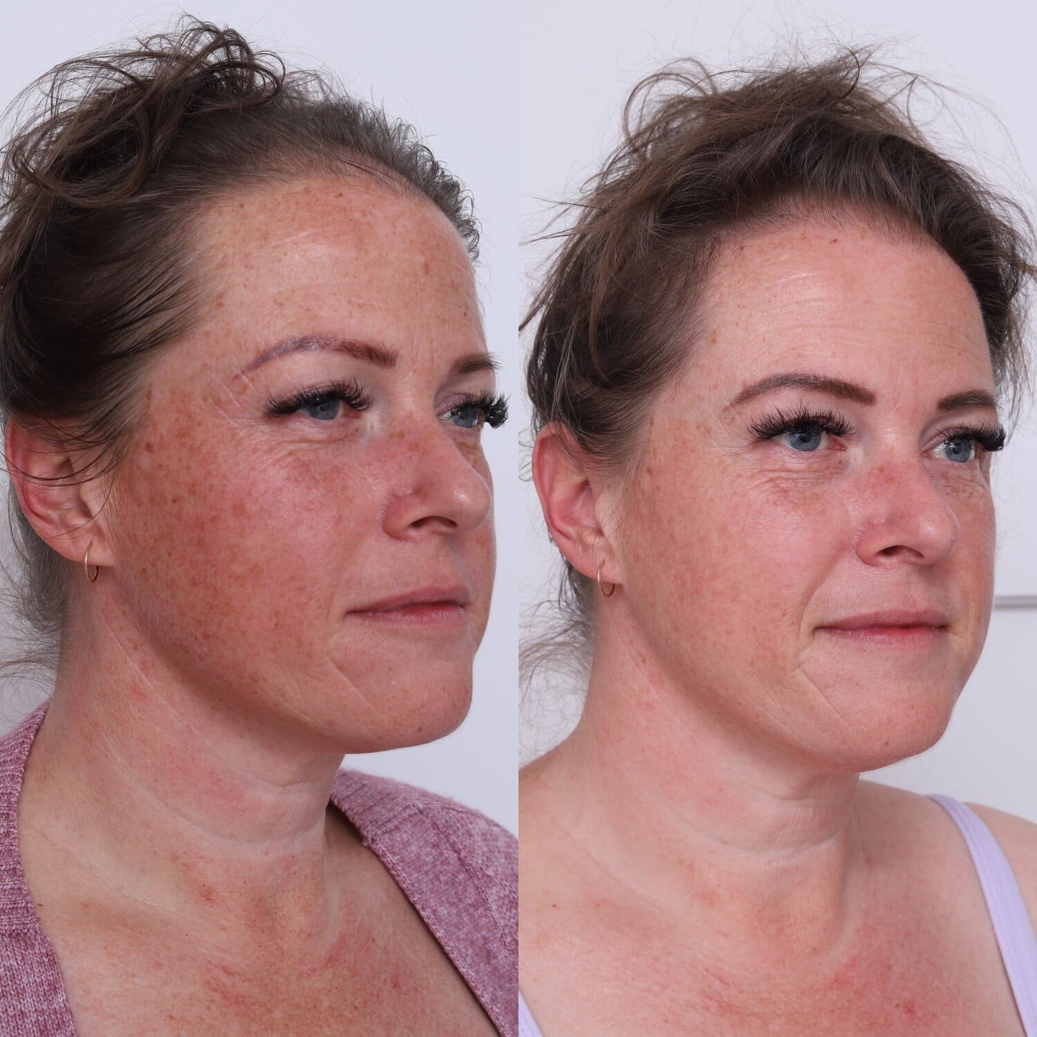 Pigmentation before and after at Dr Marion Chan's practice
