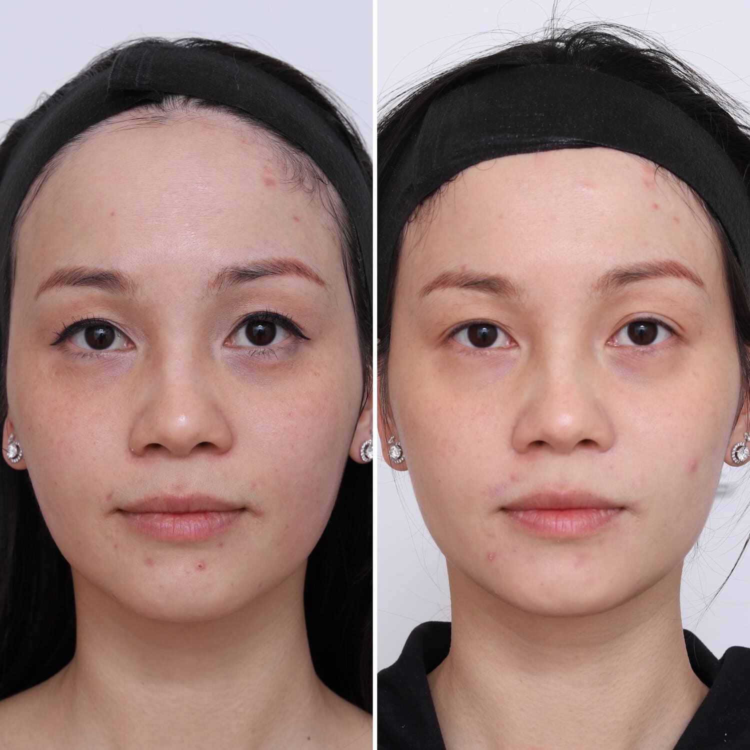 Rejuran skin healing before and after at Dr Marion Chan's practice