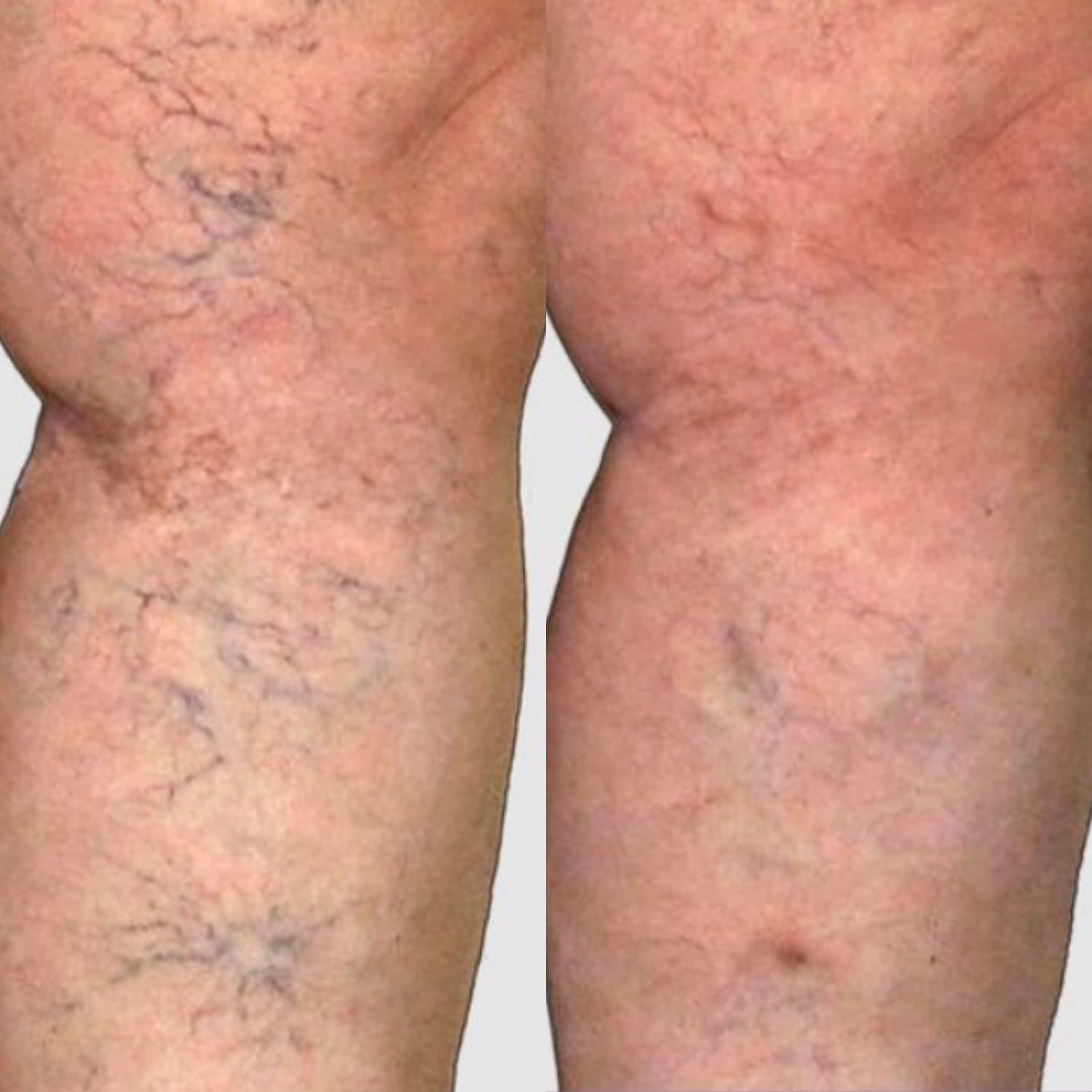Vascular & redness before and after at Dr Marion Chan's practice