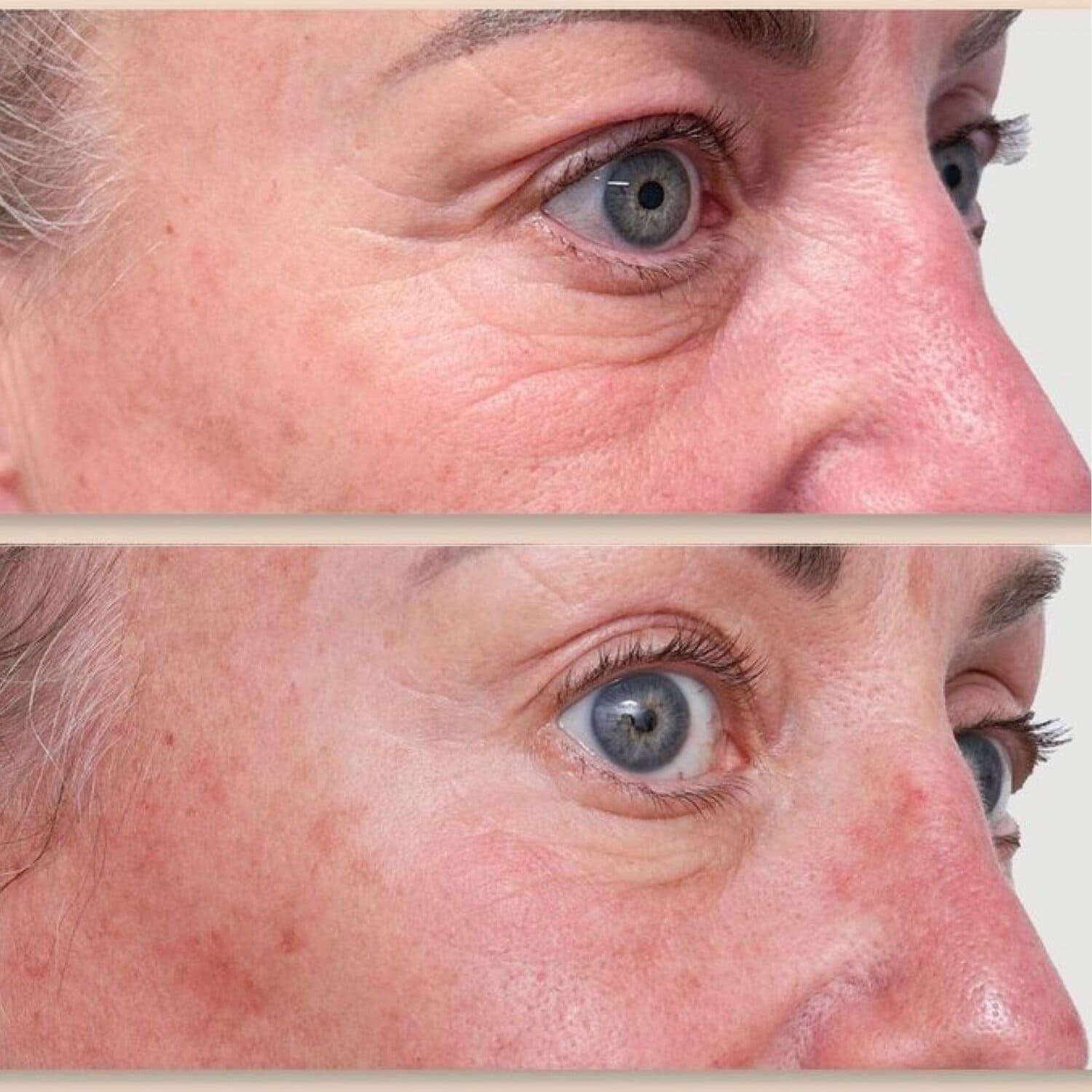 Wrinkle management before and after at Dr Marion Chan's practice